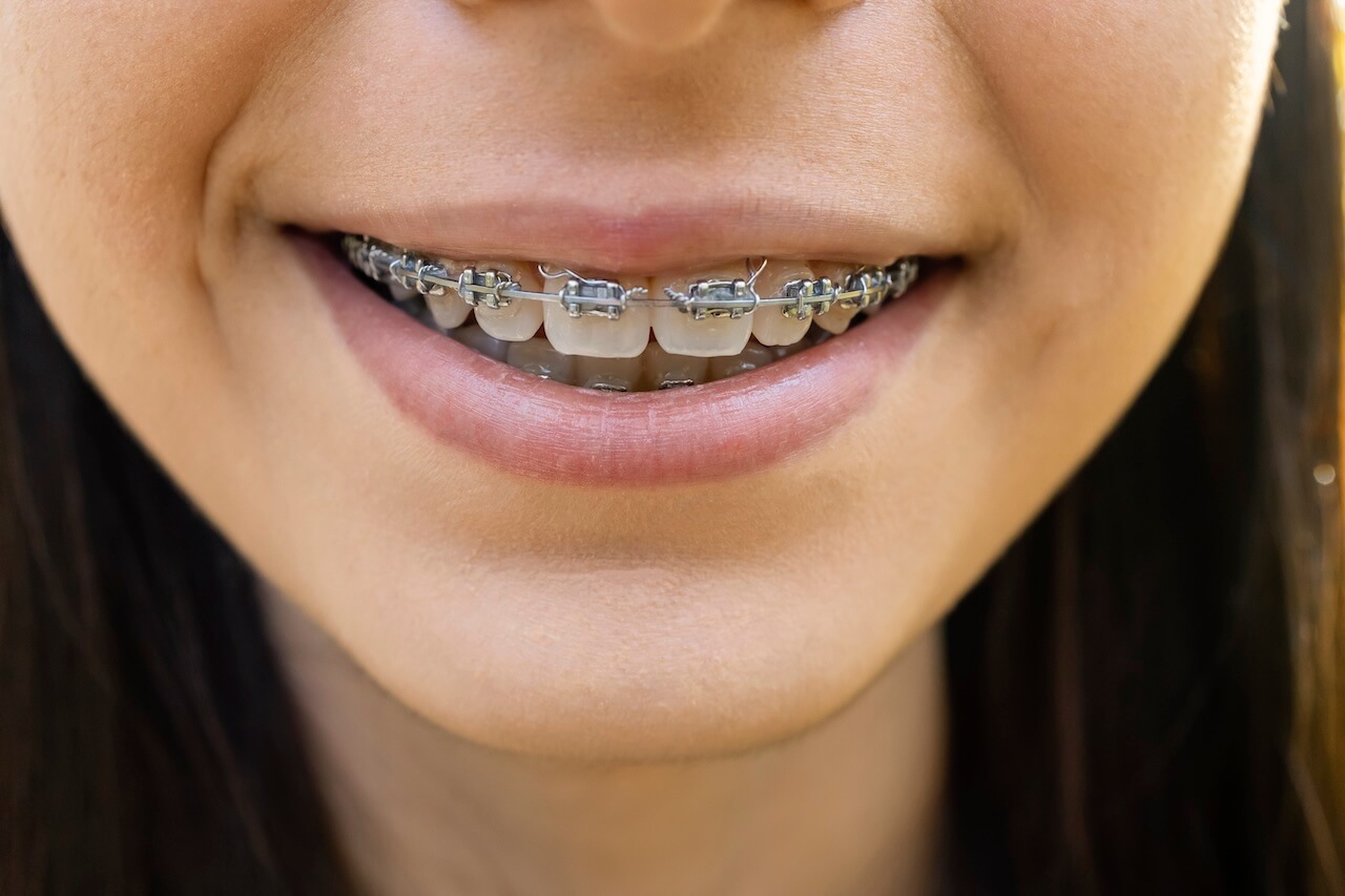 Image for Lasertechniek in de orthodontie
