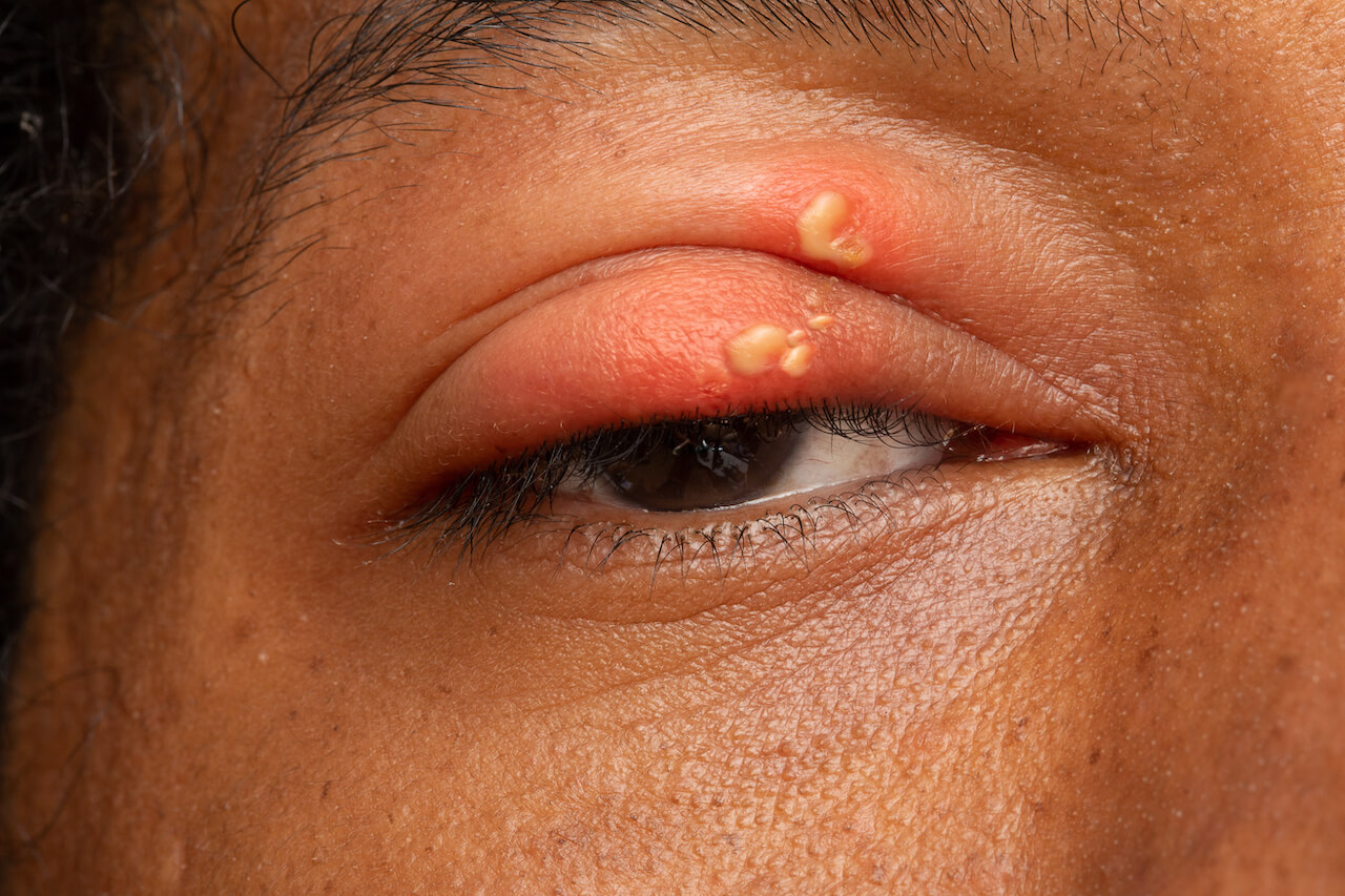 Herpes op ooglid