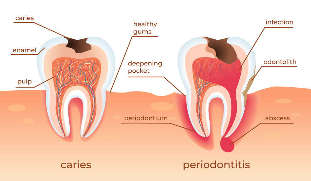 verloop van botverlies en periodontitis