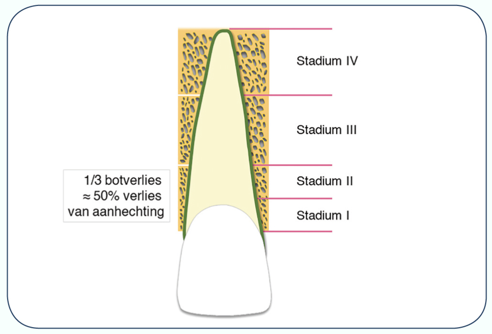 Statia van tandvleesontsteking en bot ontsteking - Parodontitis