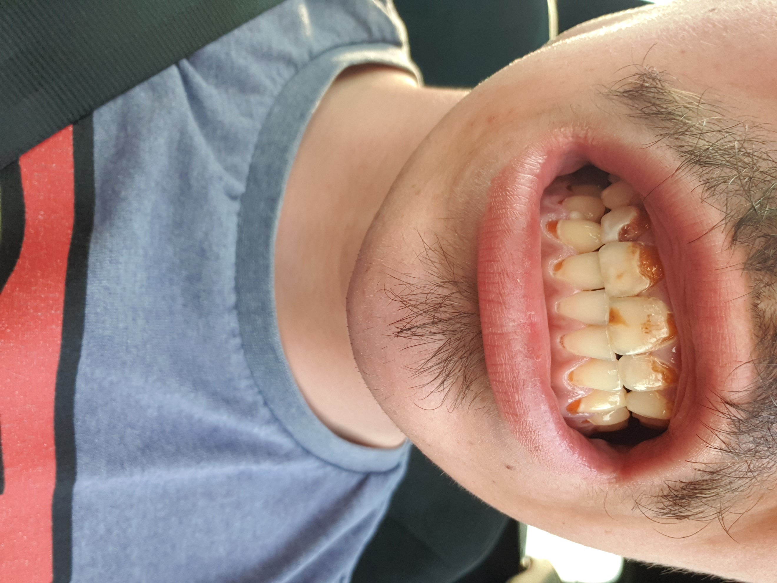 Vloeibaar Winkelier sector Heel erg slechte tanden op jonge leeftijd (22) | Tandarts.nl Forum