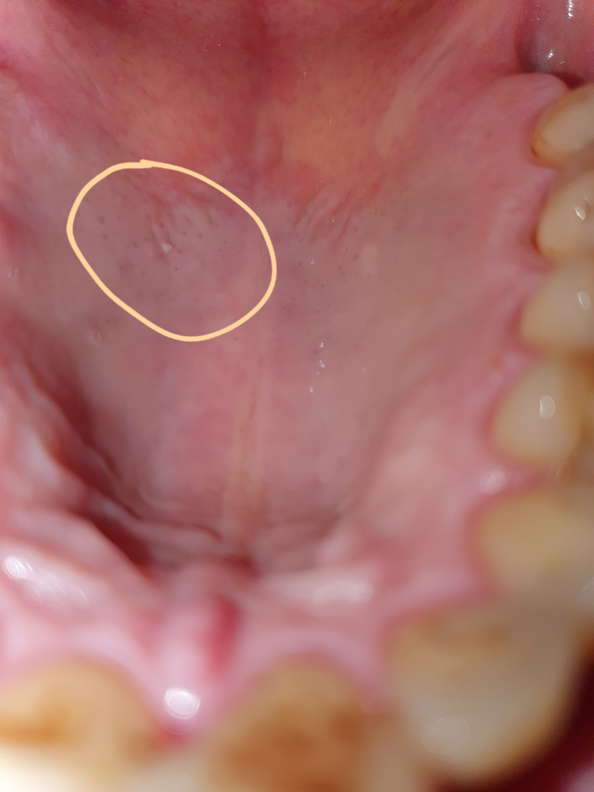 Plekje Op Gehemelte Tandarts Nl Forum