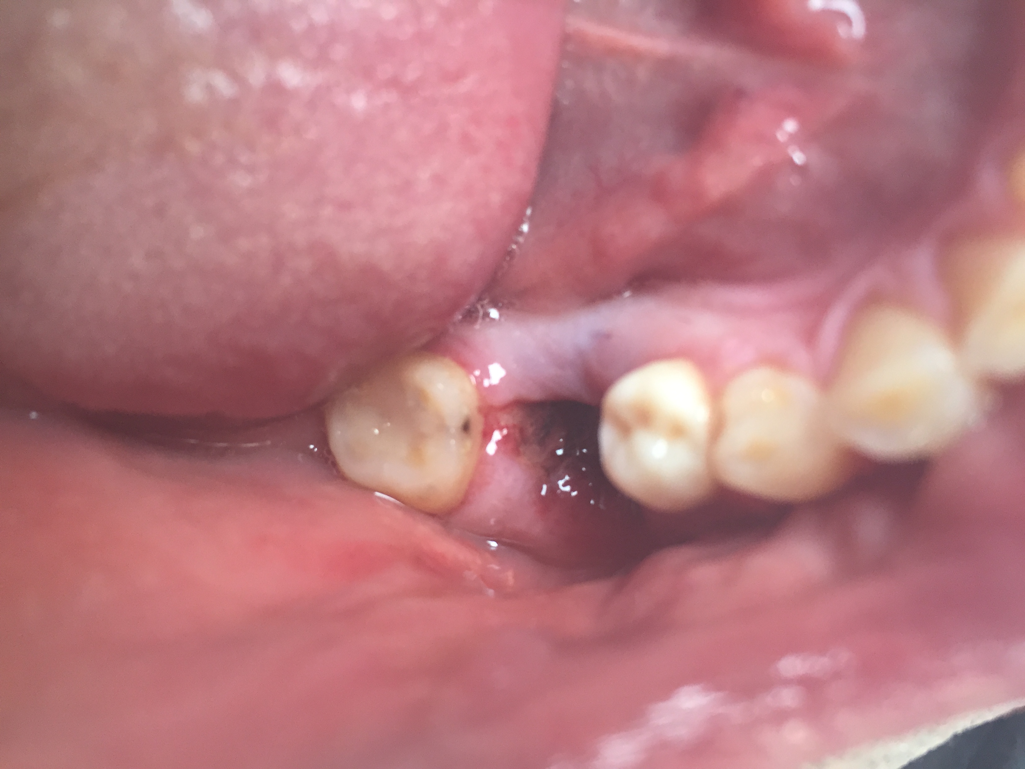 Nazorg na het trekken van één of meerdere tanden/kiezen