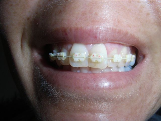 achtergrond Arresteren Permanent zeer gevoelige tanden na plaatsen beugel | Tandarts.nl Forum