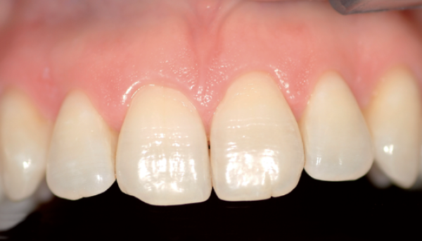 Image for Gingivitis (Bloedend tandvlees)