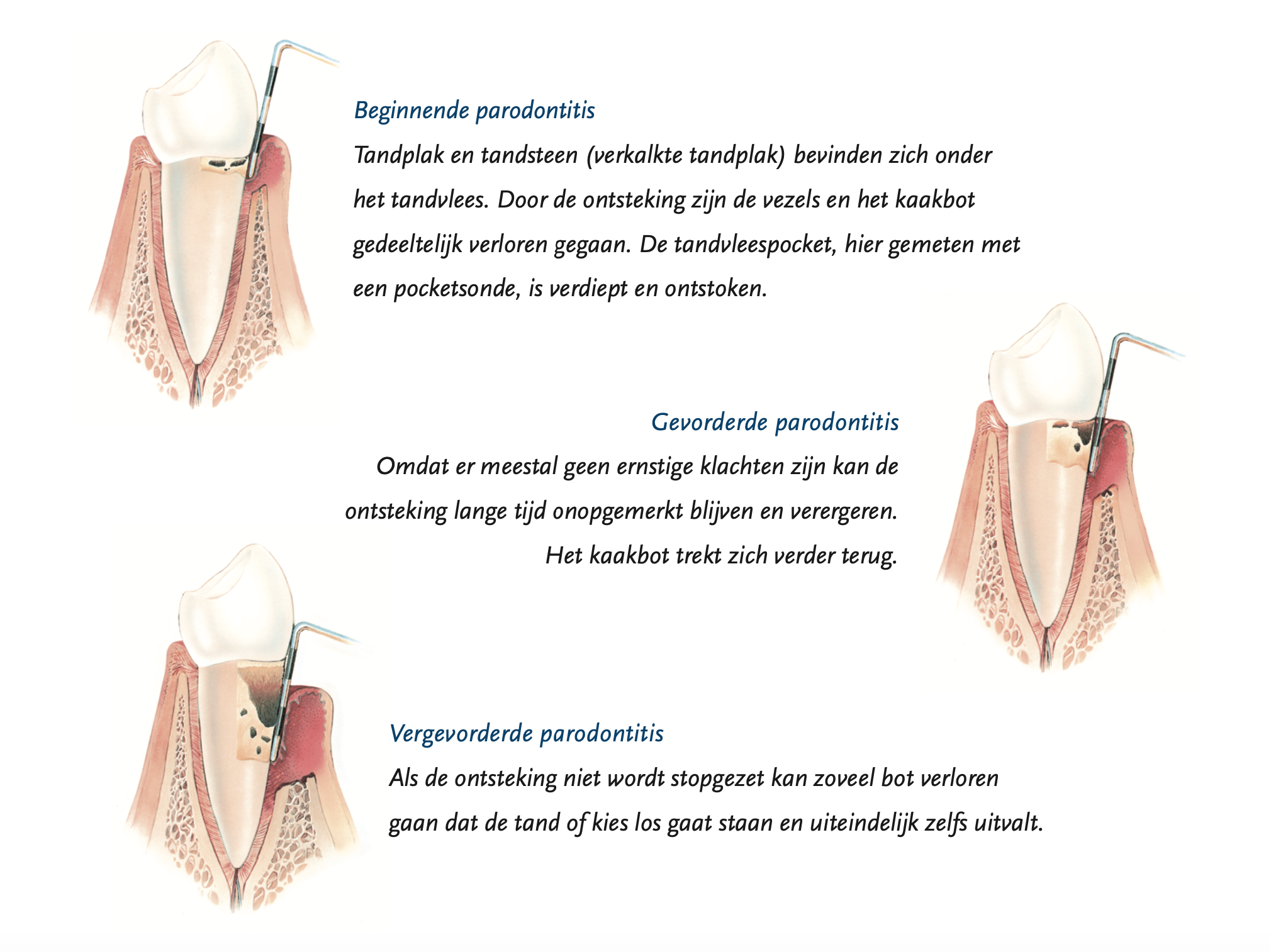 Image for Parodontitis (ernstige tandvlees ontstekingen)