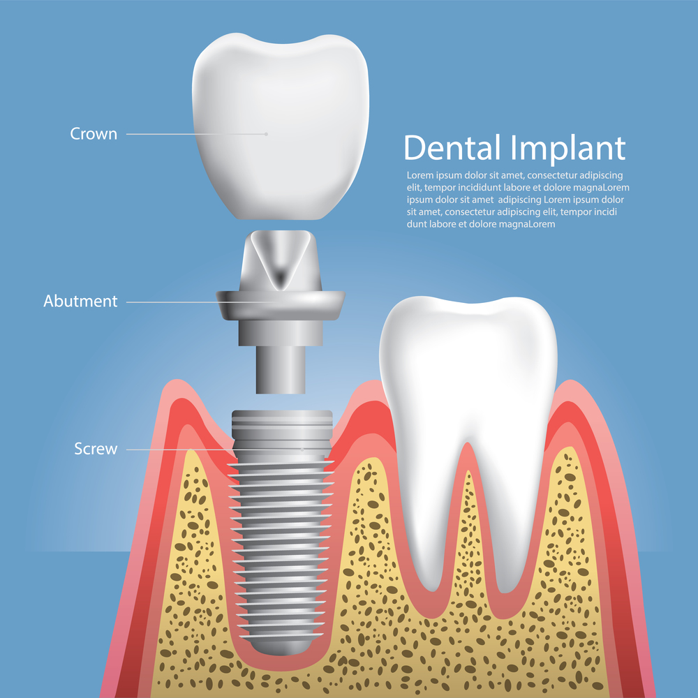 Alles over implantaten