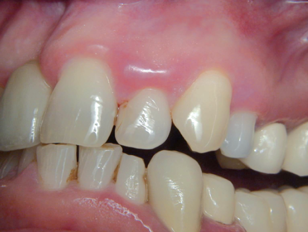 Image for Tandvleesontsteking