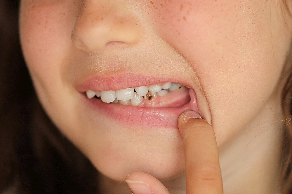Image for Gaatjes (ook wel cariës genoemd)