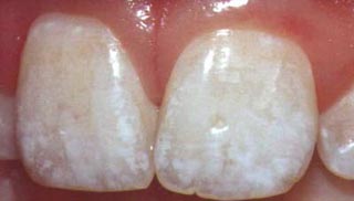 Image for Fluorose
