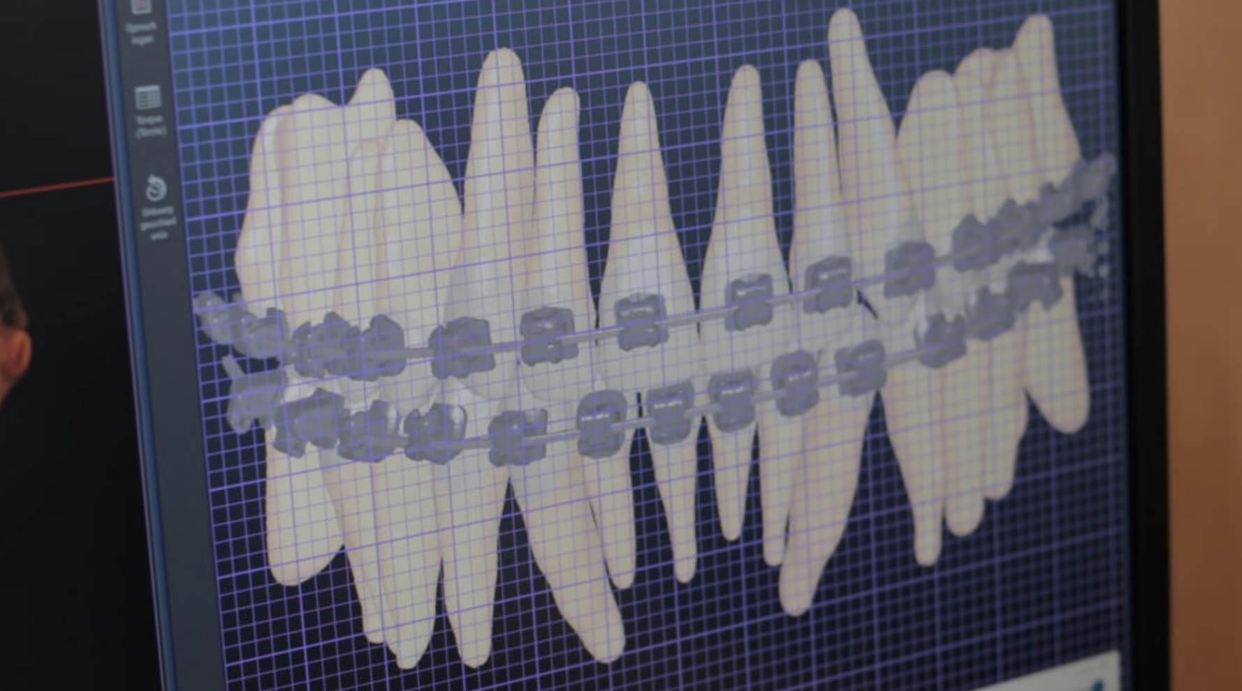 Laser in de Orthodontie 