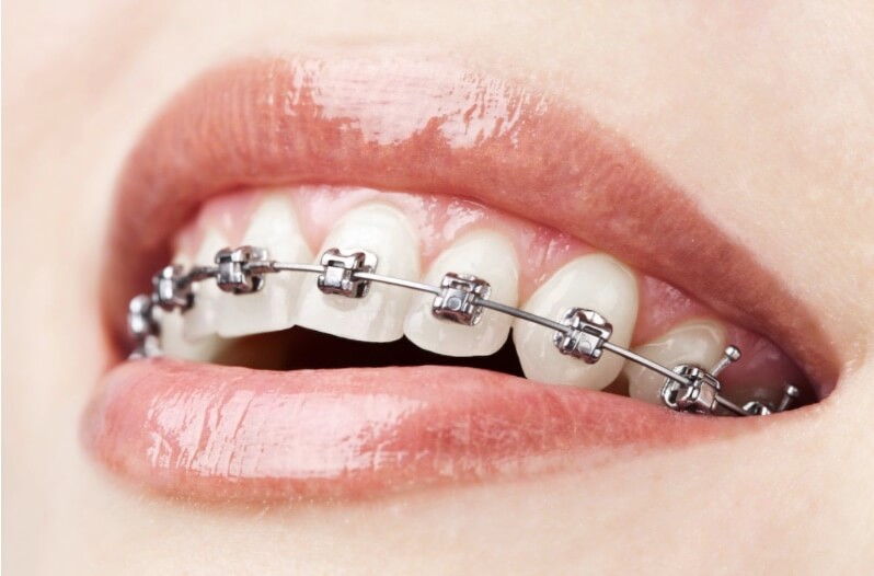 Image for Beugels en orthodontie