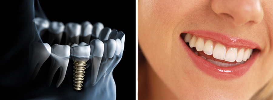 Alles wat u moet weten over implantaten en hun toepassingen