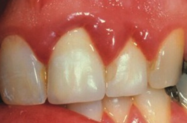 Image for Bloedend tandvlees