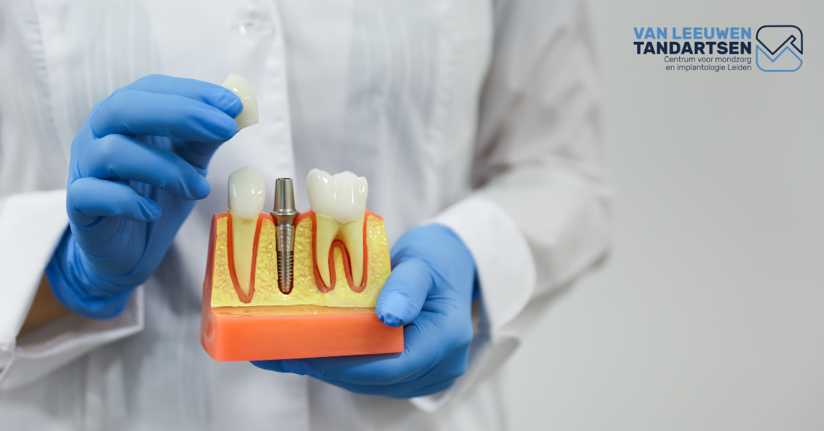 Implantologie bij Tandartspraktijk Van Leeuwen - Innovatieve en betrouwbare oplossing voor een gezond gebit