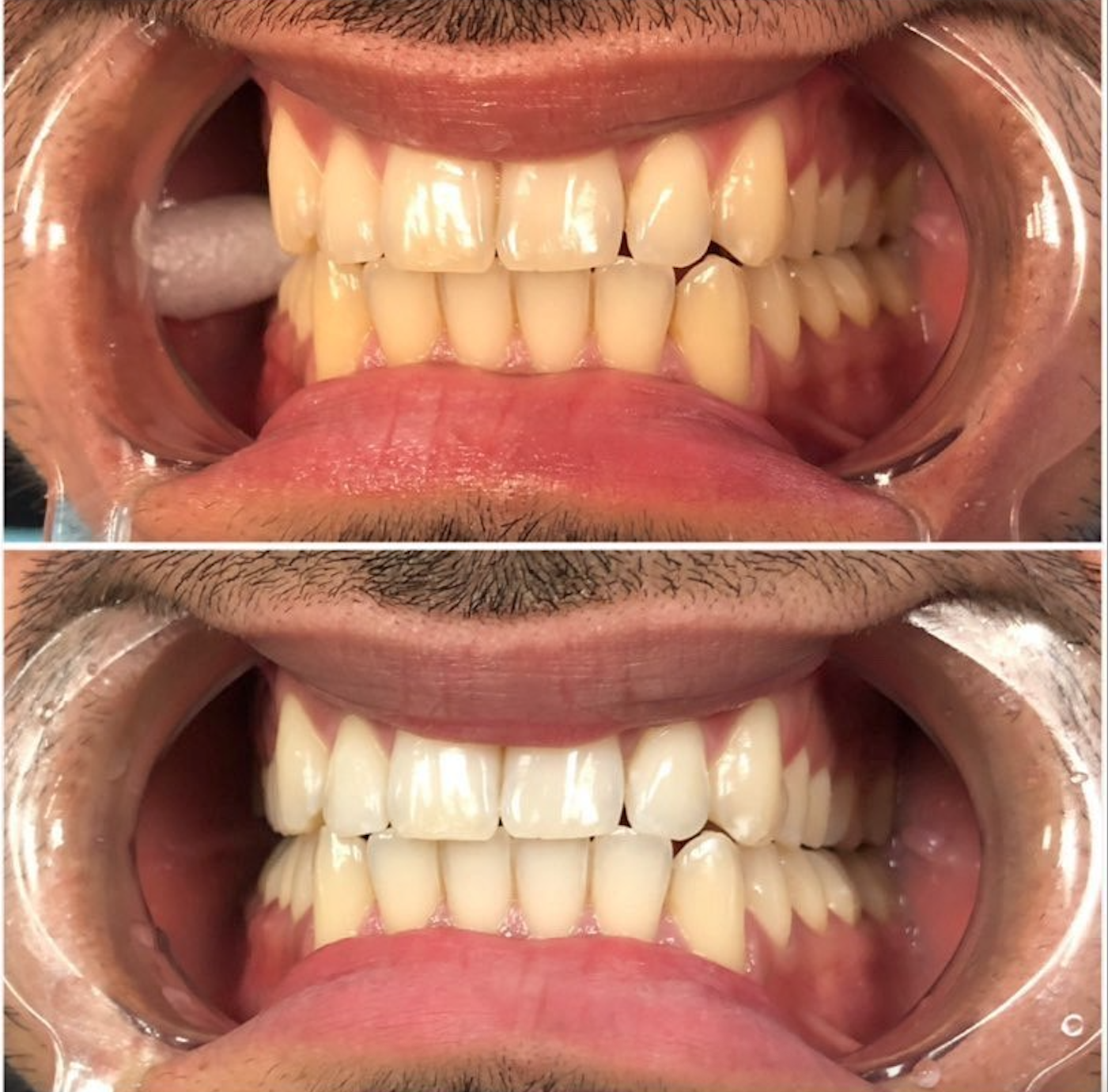 Alles wat je moet weten over tanden bleken - Tandartseninveenendaal.nl
