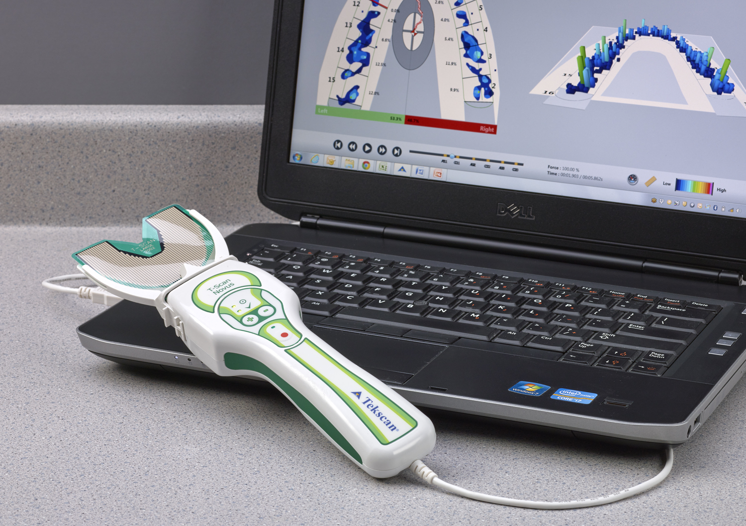 T-Scan: digitale analyse van de beet (occlusie)