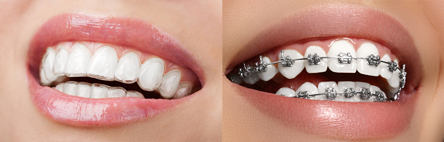 Gemiddelde duur van een orthodontische behandeling bij Tandarts Nijmegen Noord