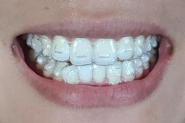 Tandartspraktijk Nijmegen - Alles wat je moet weten over Invisalign