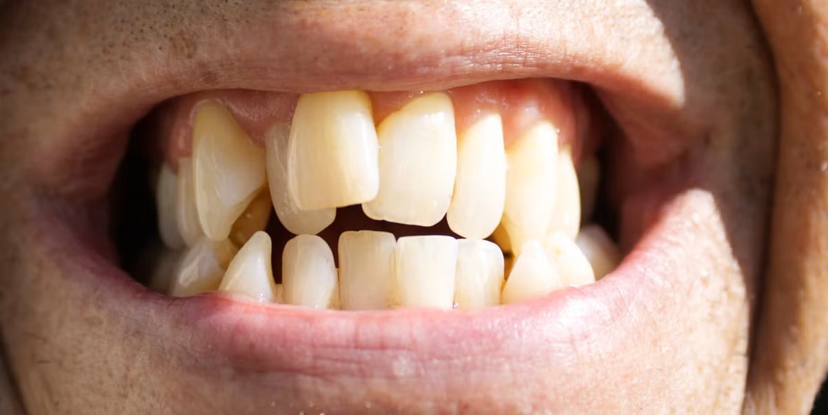 De mogelijkheden van orthodontie voor scheve tanden op latere leeftijd
