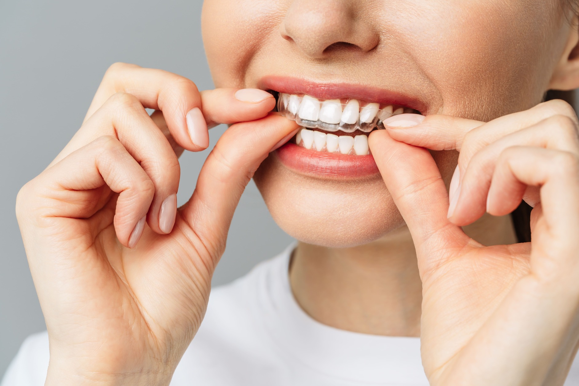 Onzichtbare beugel in Voorschoten: zo werkt Invisalign bij Tandartspraktijk Voorschoten