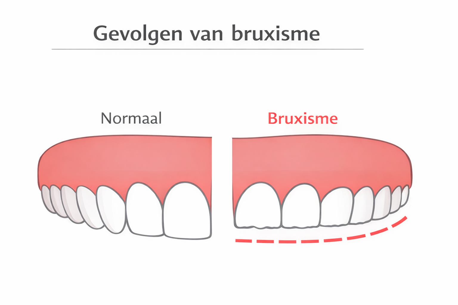 Tandarts.nl Wat kun je doen bij bruxisme?
