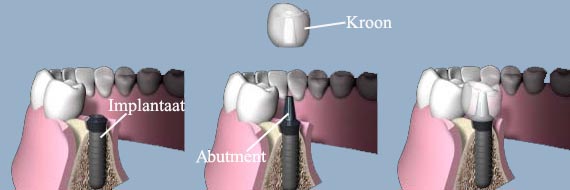 genezen stap riem Parodontologie en narcose Haarlem :: Tand implantaten