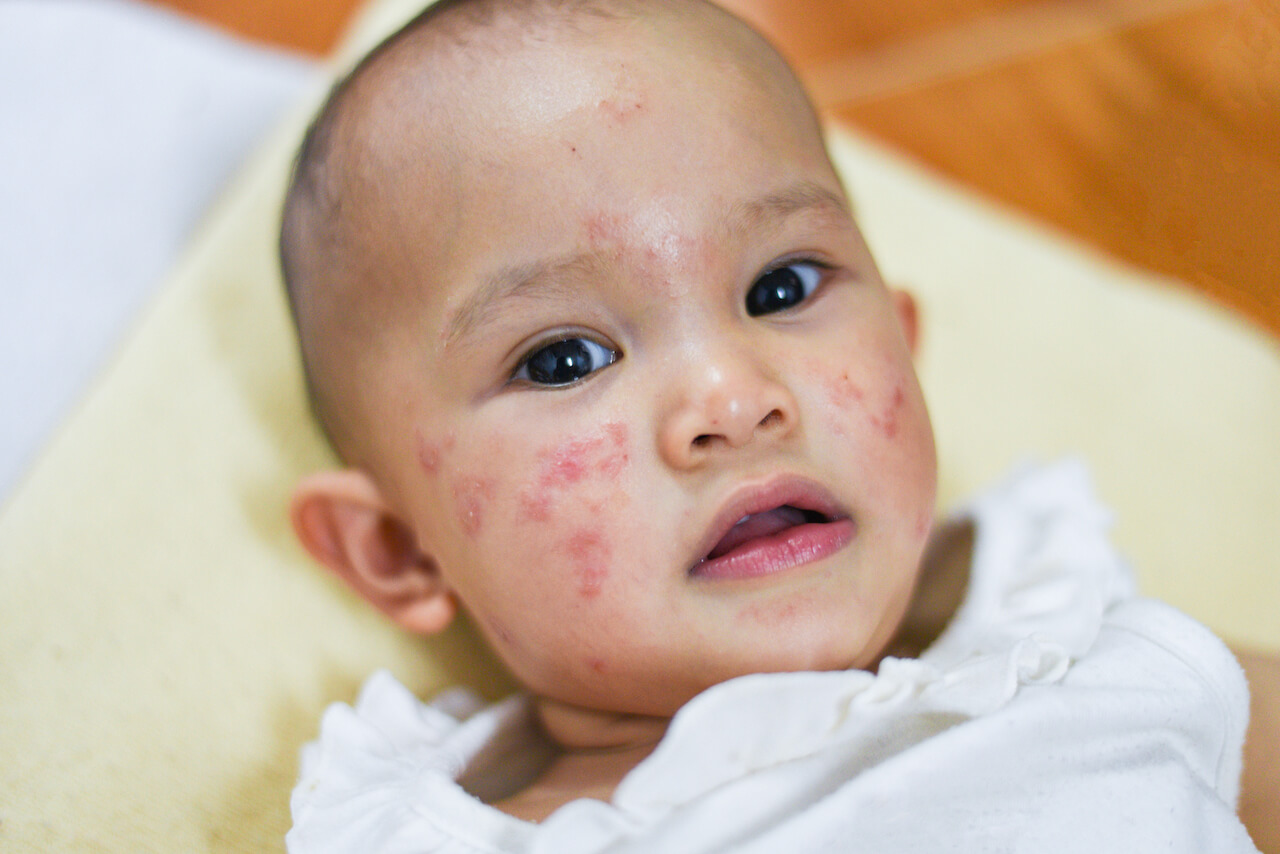 Image for De rol van mondgezondheid bij kinderen met eczeem