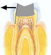Fractuur lang vulling fractuur_langs_vulling