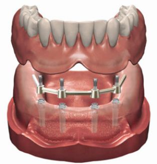 enkel Zeg opzij caravan Alles over implantaten – 0900 DENTIST