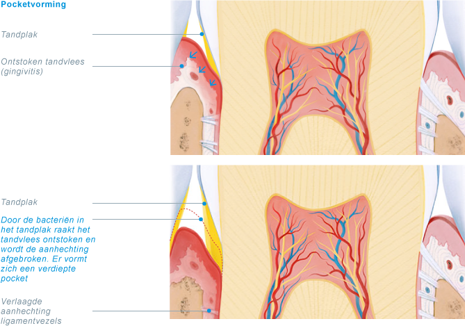 paradontitus_1