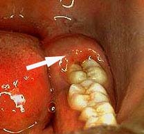 Waarom Moet De Verstandskies Vaak Verwijderd Worden? | Tandarts.Nl