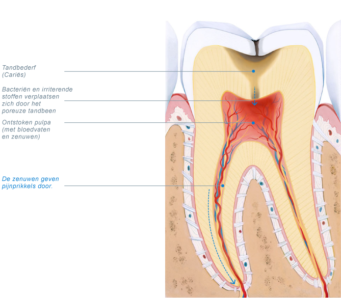 pulpitis