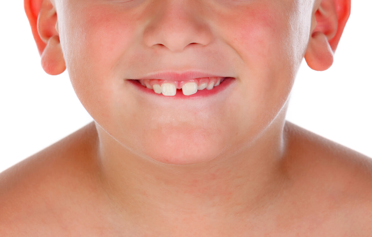 Image for Spleetje tussen de tanden