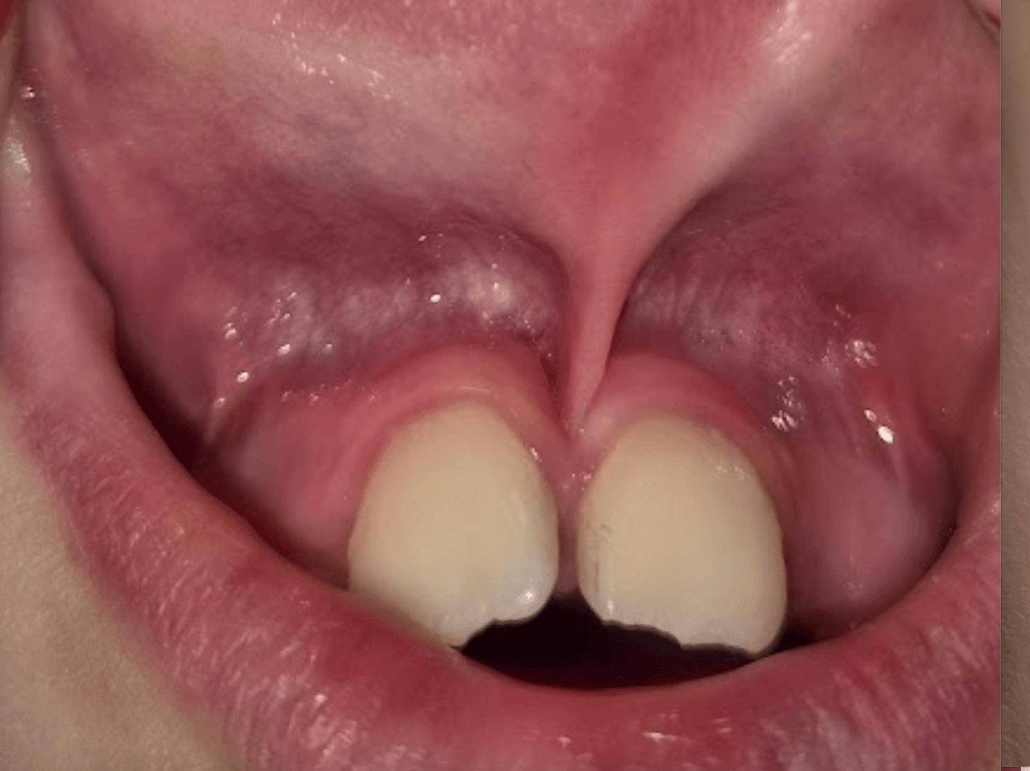 Image for Kort lipbandje bij kinderen