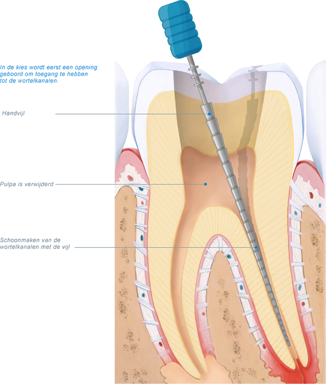 wortelkanaalbehandeling met vijl