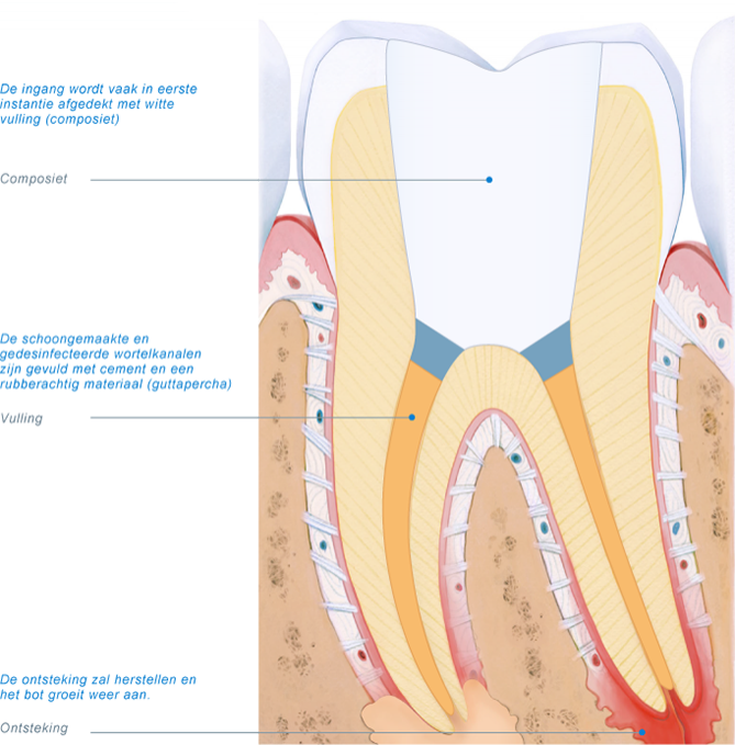 wortelkanalen gevuld met guttapercha