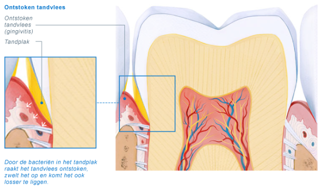 beginnende gingivitis