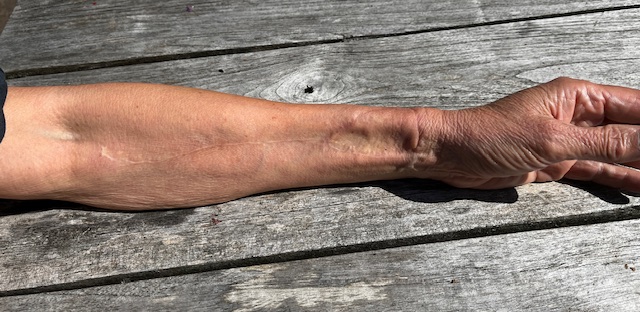 arm