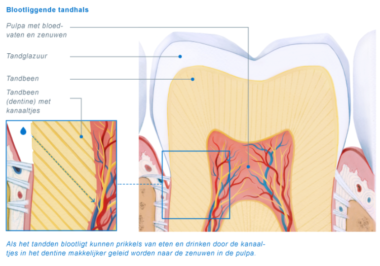 blootliggende tandhals