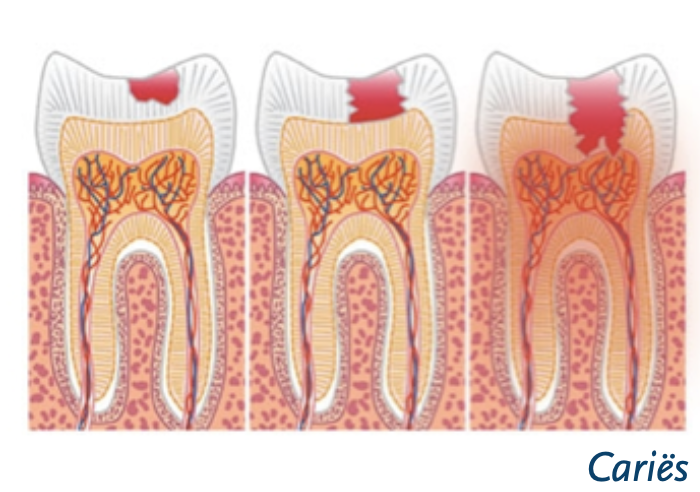 Cariës in kies