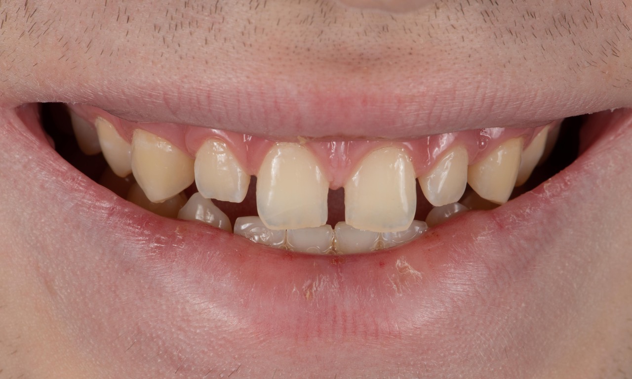Tanden met spleetje voor de behandeling