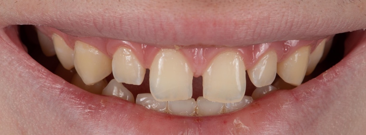 Gebit met spleetjes tussen de tanden voor een facing behandeling
