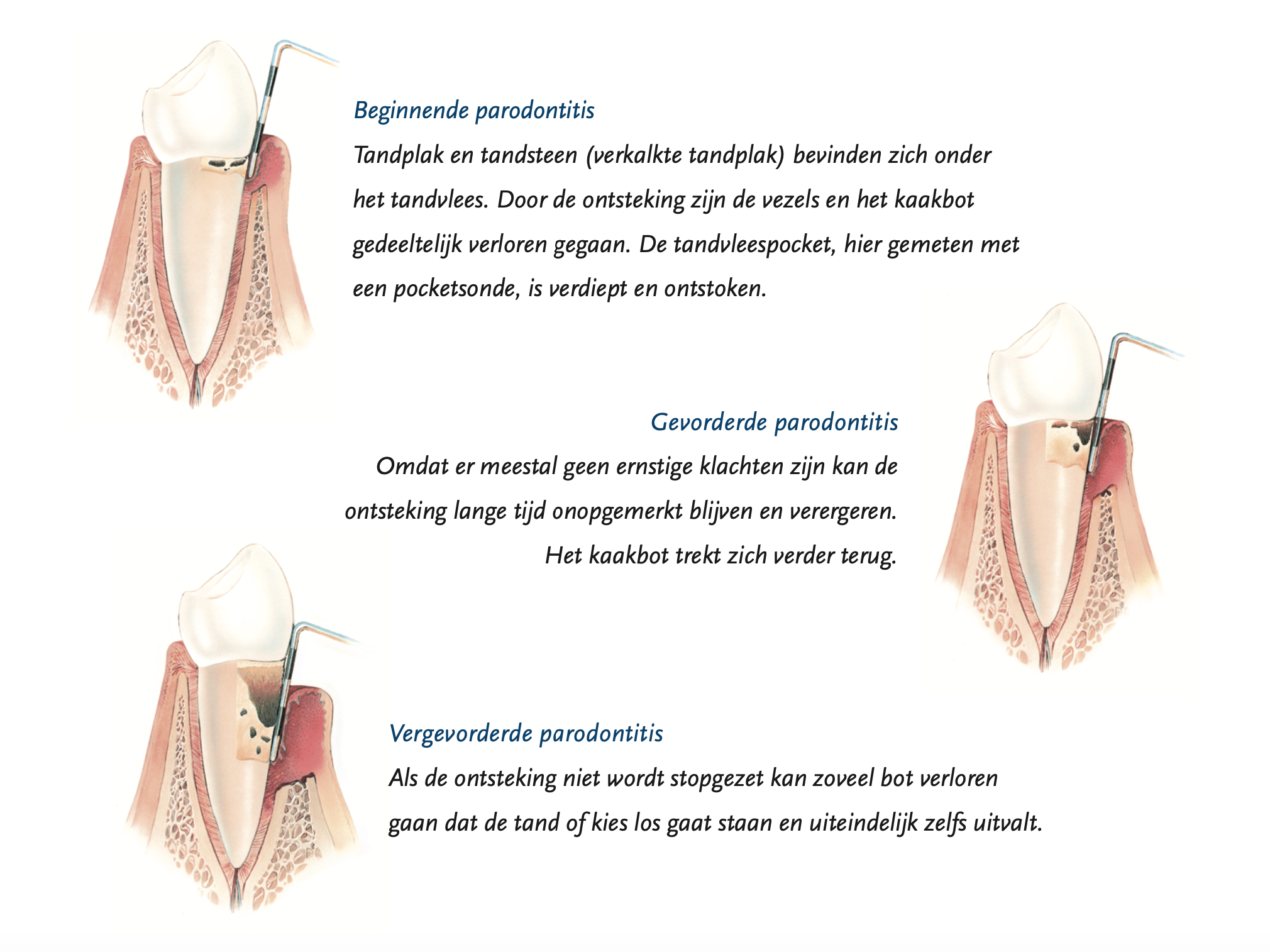 stadia van tandvlees ontsteking