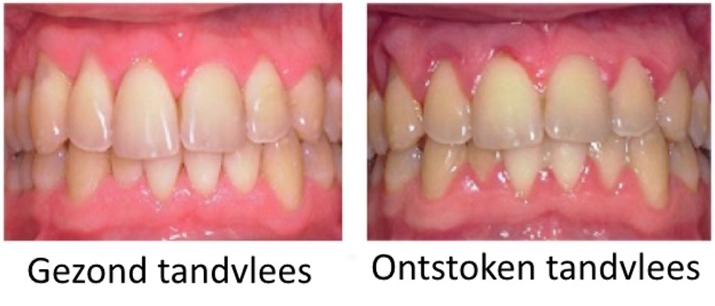 tandvlees gezond en ontstoken
