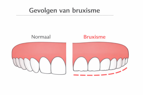 Tandarts.nl Wat kun je doen bij bruxisme?